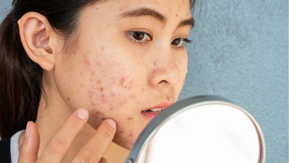 O cuidado básico para evitar a acne envolve três fases: limpeza, hidratação e proteção