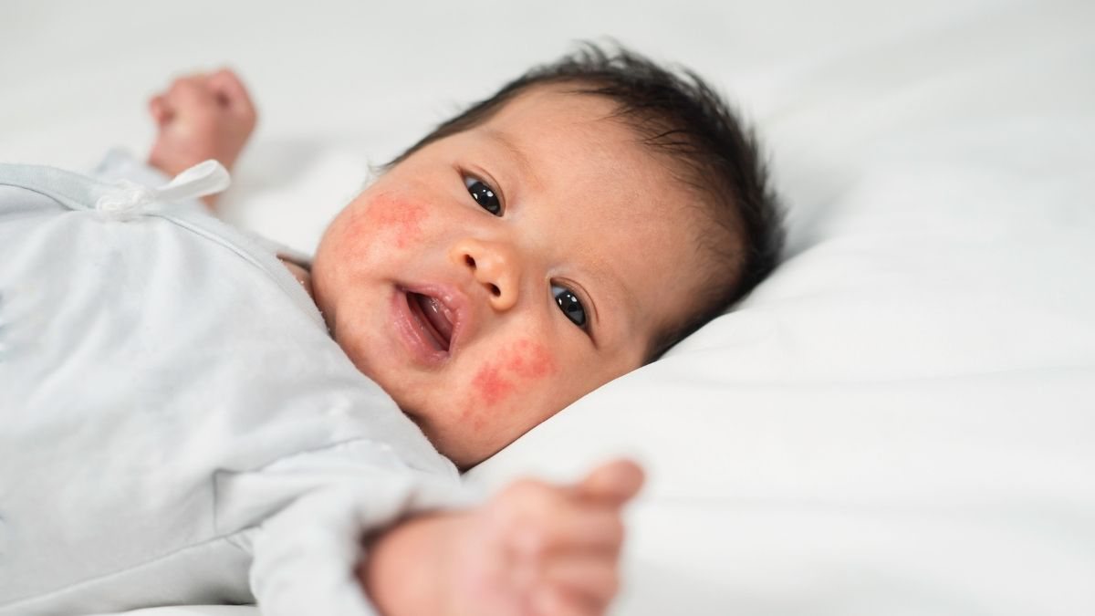 Alergia em bebês: saiba as principais causas de vermelhidão na pele