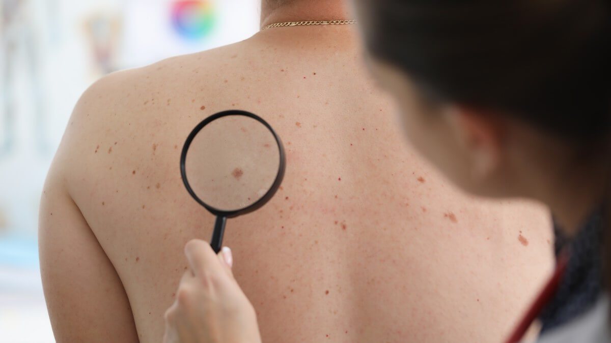 Dezembro Laranja: saiba quais são os sintomas do câncer de pele