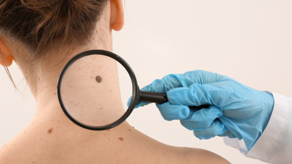 Câncer de pele: Entenda o que é o melanoma