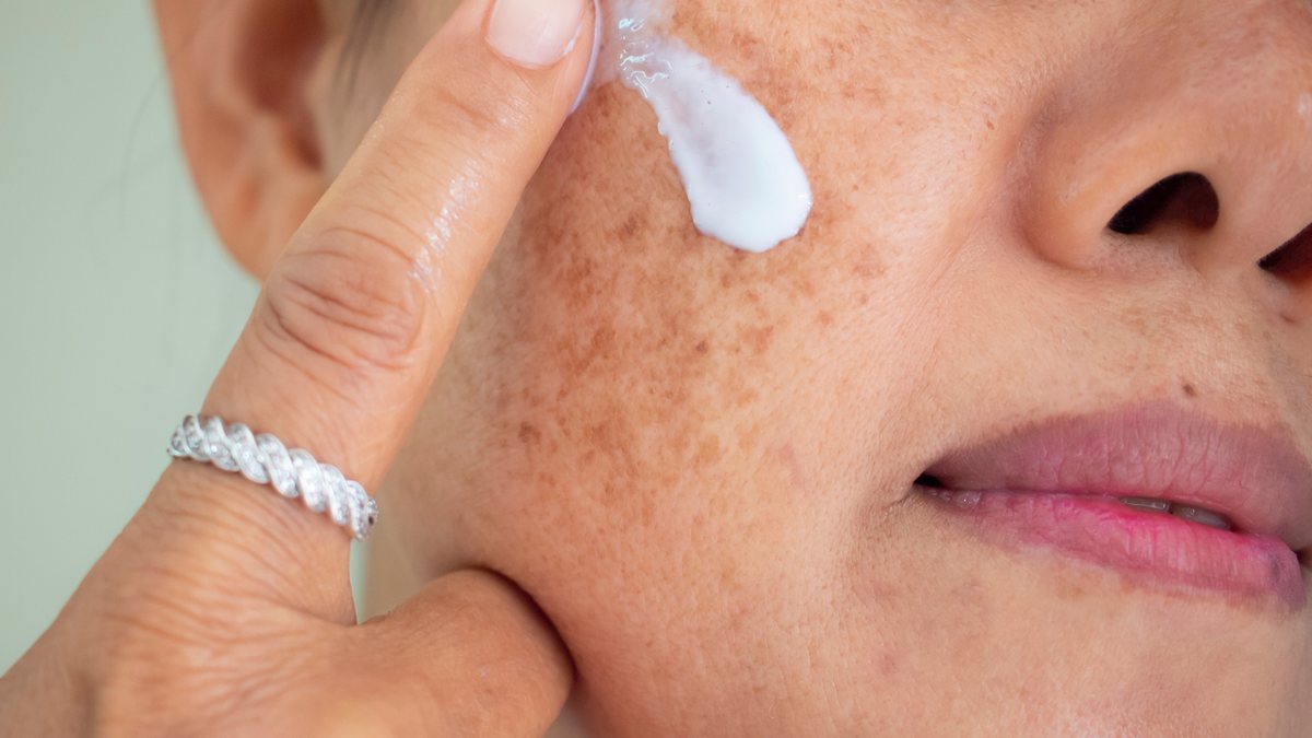 Melasma: Doença crônica causada pela exposição solar tem tratamento