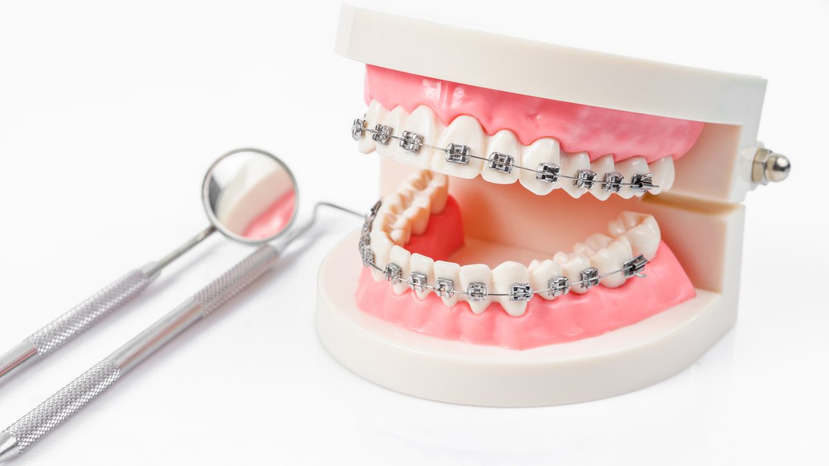 O nascimento do siso e falha na correção dos dentes podem afetar o resultado