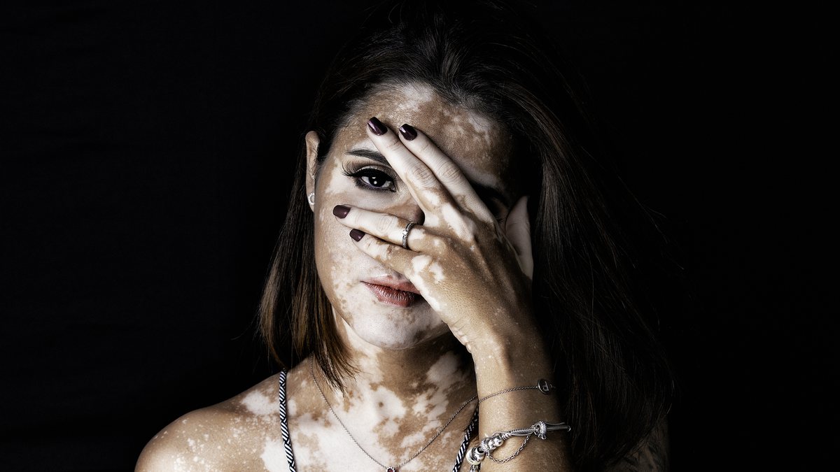 Vitiligo: Entenda o que é essa doença