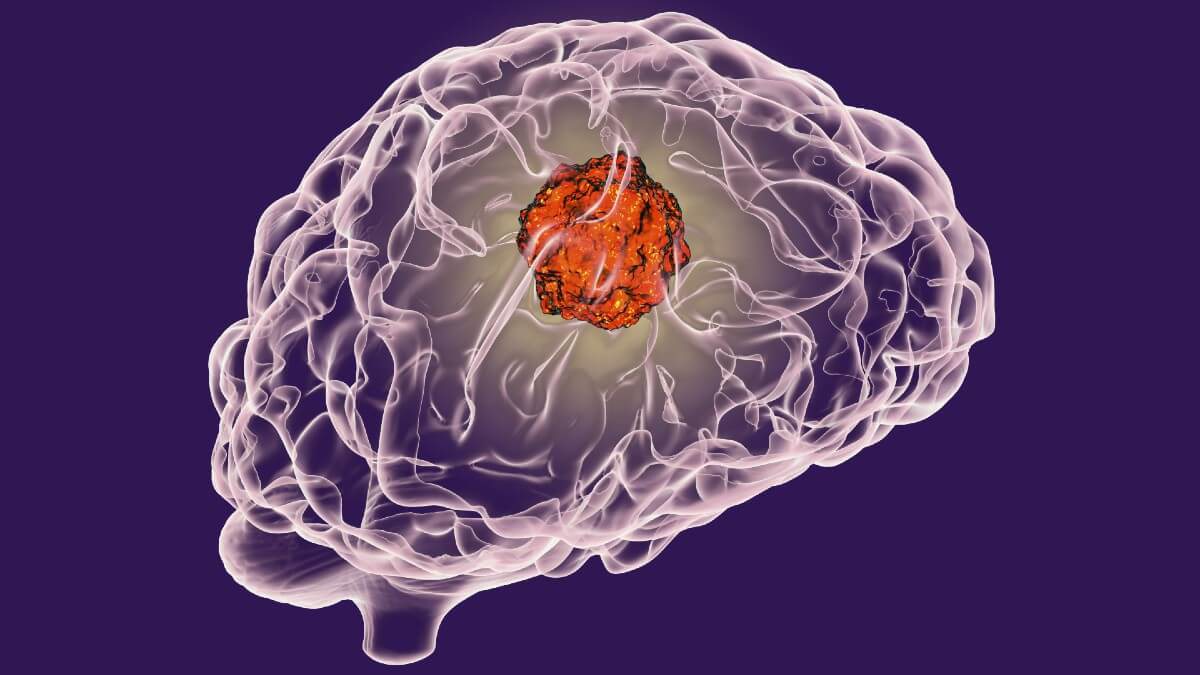 Tumor no cérebro: desequilíbrio e problemas de coordenação estão entre os principais sintomas