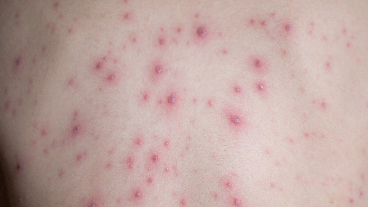 Quais são os sintomas da varíola dos macacos? Entenda a doença